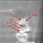上顎右側臼歯部Z軸